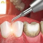đối với các trường hợp bệnh nha chu nặng, nha sĩ có thể chỉ định cạo vôi răng 3 tháng/lần