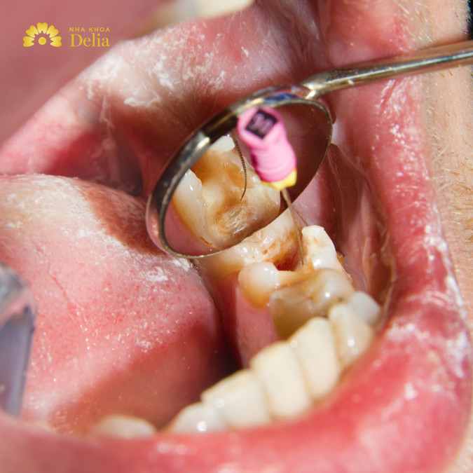 Lấy tủy răng lần 1 vẫn còn đau phải làm sao?