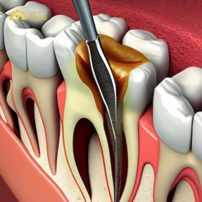 Lấy tủy răng lần 2 có đau không, bác sĩ giải đáp chi tiết