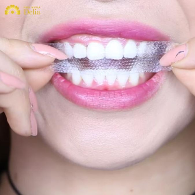 Miếng dán trắng răng có tốt không? Khi dùng cần lưu ý gì?