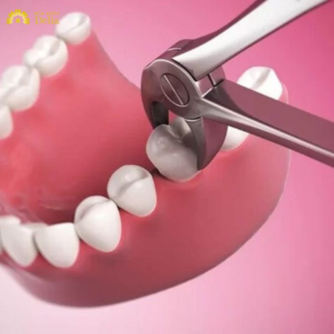 Trả lời thắc mắc: Nhổ răng nhai bao nhiêu tiền? Đắt hay rẻ?