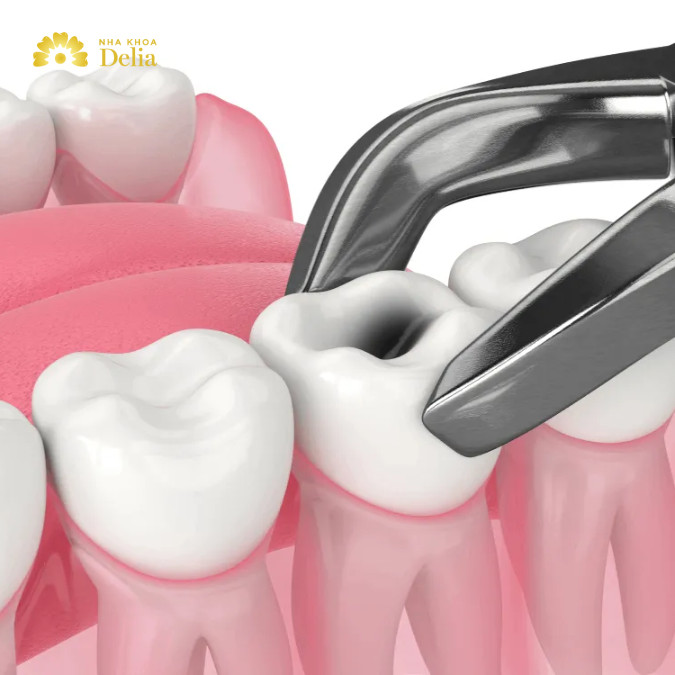 Nhổ răng sâu có ảnh hưởng gì không, có nên nhổ răng sâu không?