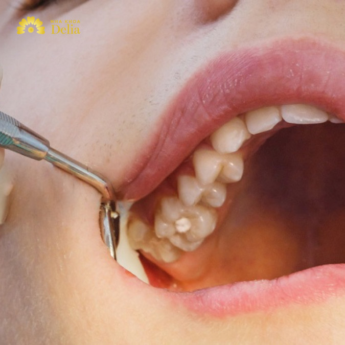 Nhổ răng sâu hàm trên có đau không, có ảnh hưởng gì không?