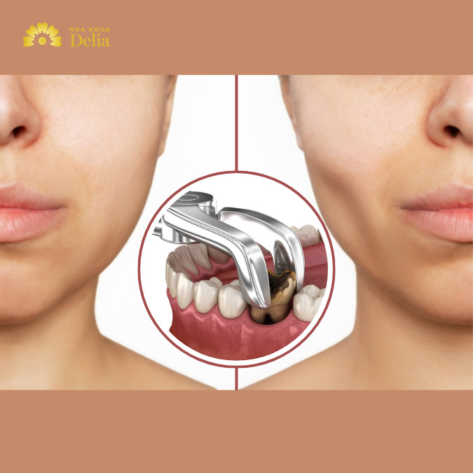 Bác sĩ giải đáp: Nhổ răng số 4 có bị hóp má không?