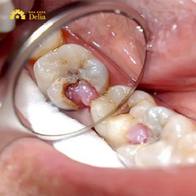 Răng sâu lồi thịt có nhổ được không?