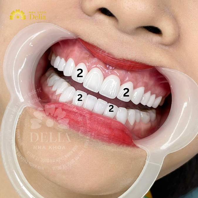 Răng số 2 nằm ở vị trí nào, vai trò trong cung hàm ra sao?