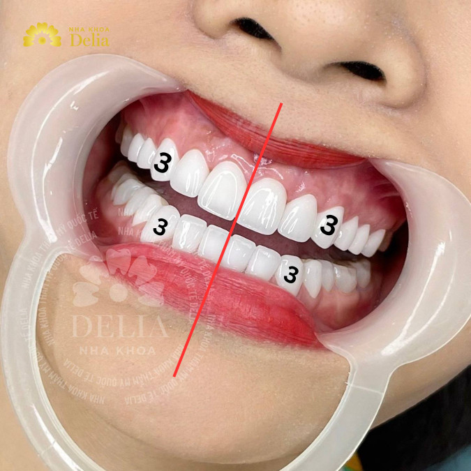 Răng số 3 là răng nào, bị mất răng số 3 phải làm sao?