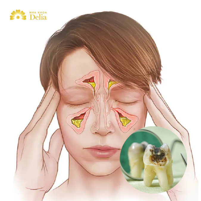 Sâu răng gây viêm xoang như thế nào?
