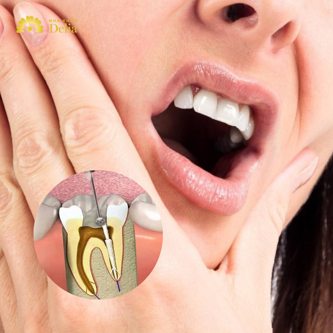 Phân biệt các triệu chứng sau khi lấy tủy răng – Khi nào cần gặp bác sĩ?