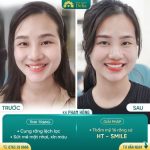 Chị Phạm Hồng sau khi được đội ngũ bác sĩ tư vấn đã quyết định lựa chọn răng sứ HT Smile