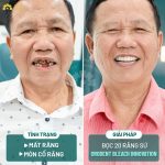 Quá trình bọc 20 răng sứ Orodent Bleach Innovation của chú Đào diễn ra trong 2 buổi