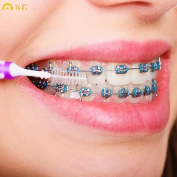 [Chia sẻ] Hướng dẫn cách vệ sinh niềng răng mắc cài