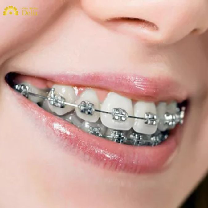 Chi phí niềng răng mắc cài kim loại tại nha khoa Delia đắt hay rẻ?