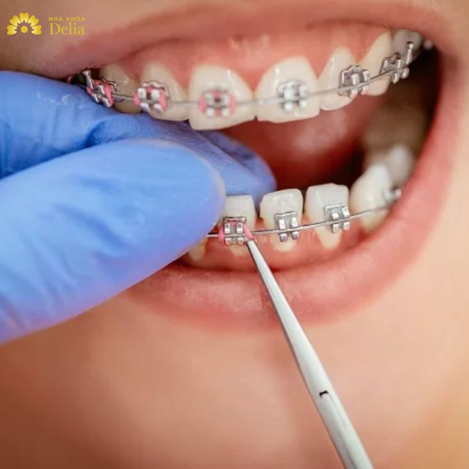 4 lưu ý khi niềng răng mắc cài kim loại quan trọng