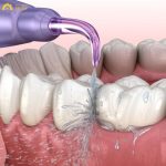 Theo khuyến cáo từ nha sĩ, nên sử dụng tăm nước trước khi đánh răng