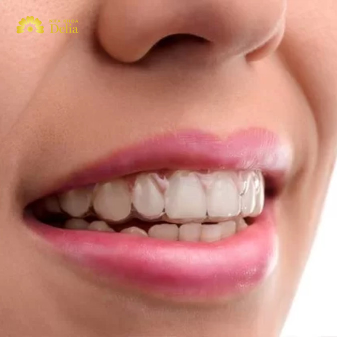 7 lưu ý khi niềng răng Invisalign bạn nhất định phải biết