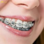 thời gian niềng răng mắc cài kim loại cho người trưởng thành với tình trạng răng trung bình thường kéo dài từ 18 đến 24 tháng