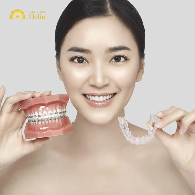 Nên niềng răng trong suốt hay mắc cài? Phương pháp nào tốt hơn