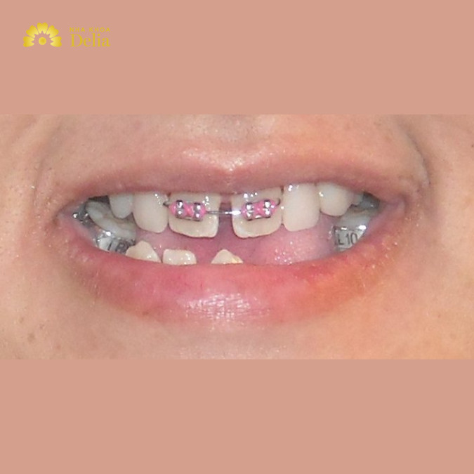 Niềng 2 răng cửa bị hô bao nhiêu tiền, đắt hay rẻ?