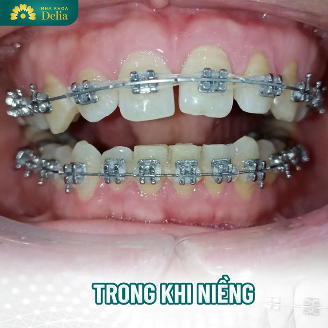 Sự thật về niềng răng 10 triệu trọn gói có hiệu quả không?