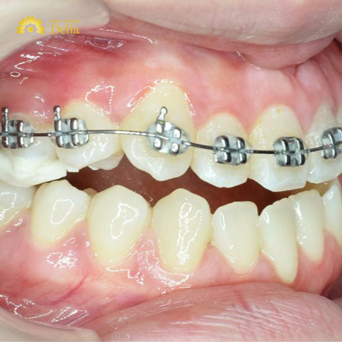 Niềng răng 15 triệu nên chọn loại nào hiệu quả – Bác sĩ giải đáp nhanh