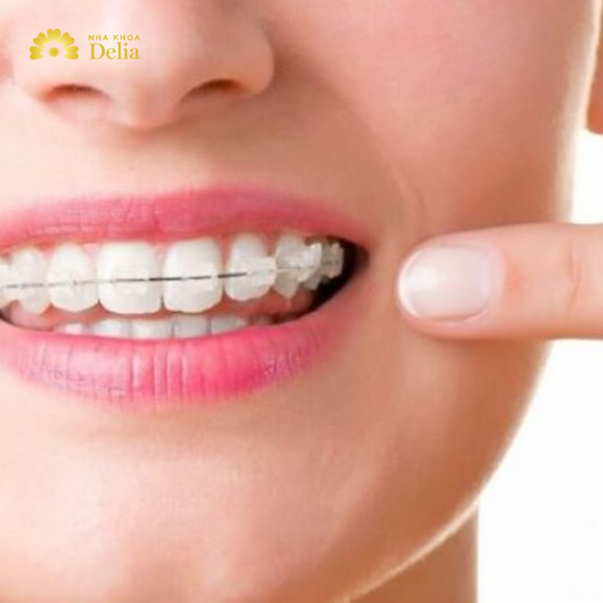 Niềng răng 40 triệu nên dùng loại nào tốt nhất, có hiệu quả không?