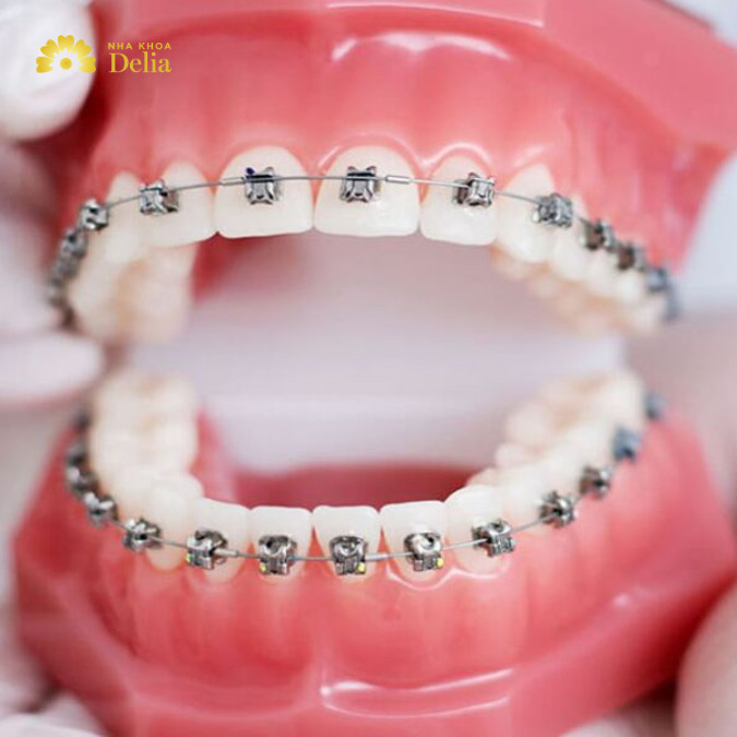 Niềng răng 5 triệu có thực sự hiệu quả không? Bác sĩ giải đáp