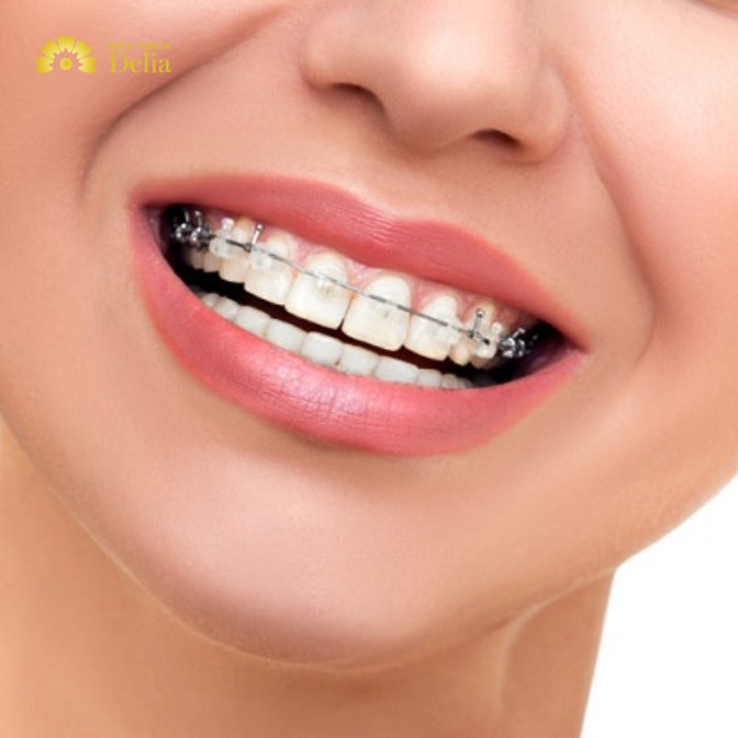Niềng răng hàm trên bao nhiêu tiền? Niềng hàm trên có hiệu quả không?