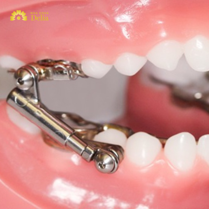 Niềng răng lệch hàm bao nhiêu tiền? Tổng chi phí hết bao nhiêu?