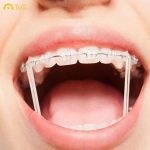 Niềng răng mắc cài tự buộc nổi bật với hiệu quả chỉnh nha nhanh chóng nhờ vào cơ chế hoạt động thông minh