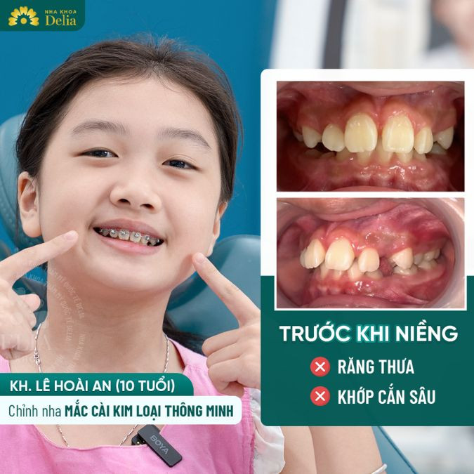 Niềng răng mắc cài có đau không? Giai đoạn nào đau nhất?