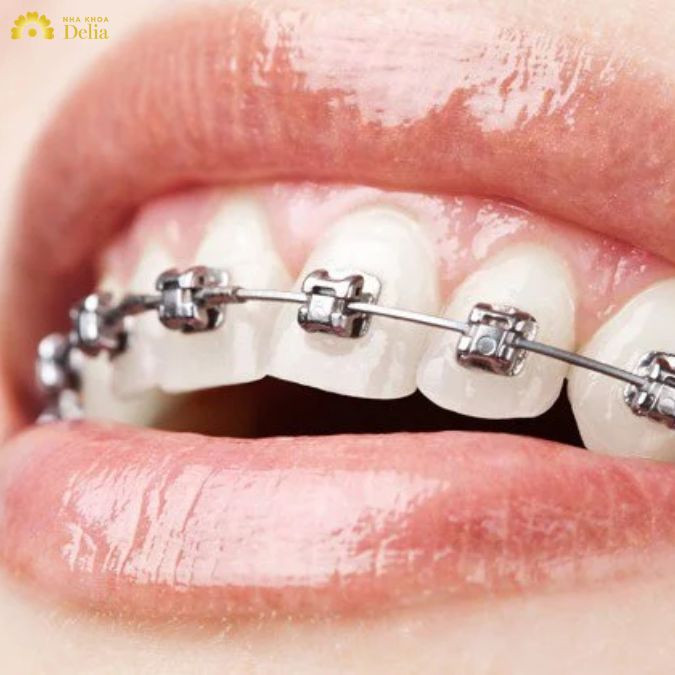 Trả lời thắc mắc: Niềng răng mắc cài kim loại có đau không?