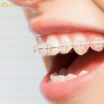 Niềng răng mắc cài sứ là phương pháp chỉnh nha hiện đại sử dụng hệ thống mắc cài và dây cung được làm từ chất liệu sứ cao cấp