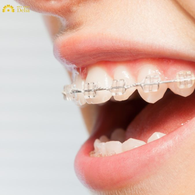 Niềng răng mắc cài sứ có mấy loại? Thời gian niềng ngắn hay dài?