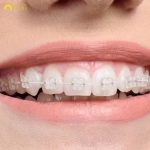 Niềng răng mắc cài sứ tự buộc