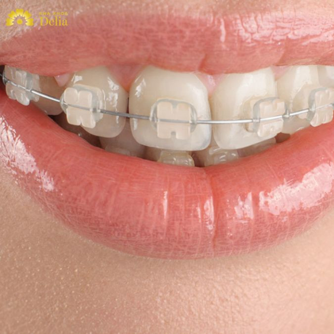 Cân nhắc chọn lựa: Niềng răng mắc cài sứ hay pha lê?