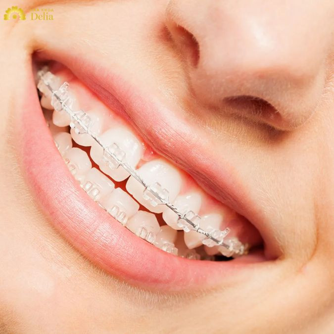 Niềng răng mắc cài sứ trong bao lâu? Mất nhiều thời gian không?