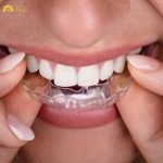 Chi phí niềng răng nhựa phụ thuộc vào nhiều yếu tố, bao gồm loại khay niềng sử dụng, tình trạng răng của bạn