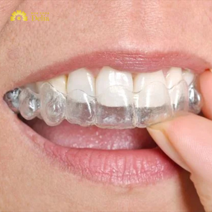 Niềng răng nhựa có thực sự tốt không? Giải đáp nhanh