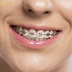 chi phí niềng răng không phải là một con số cố định mà phụ thuộc vào nhiều yếu tố khác nhau