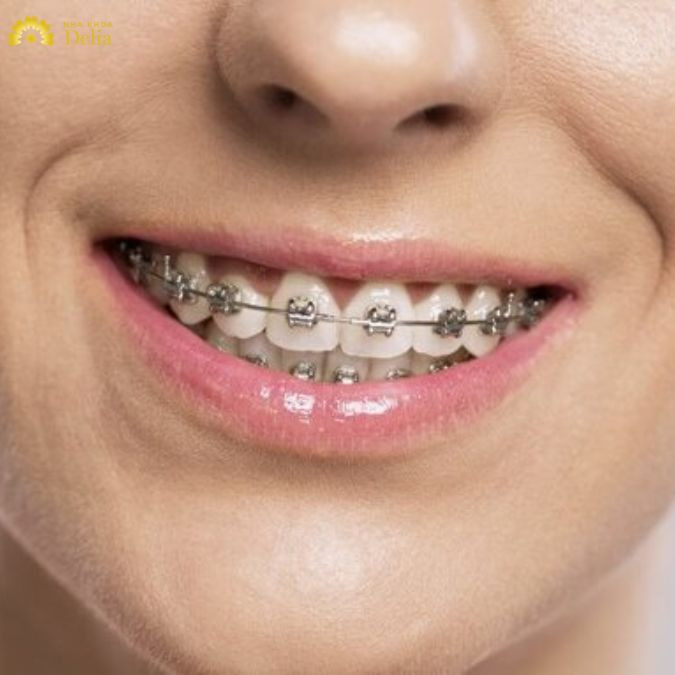 Niềng răng sắt mất bao lâu? Giá niềng răng sắt đắt hay rẻ?