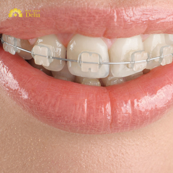 Niềng răng sứ bao nhiêu tiền, cập nhật bảng giá chi tiết