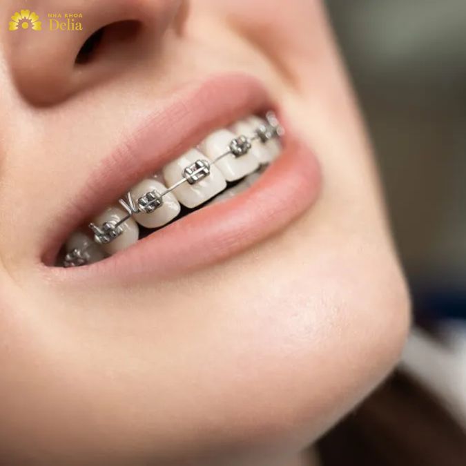 Niềng răng mắc cài titan và những điều bạn nên biết