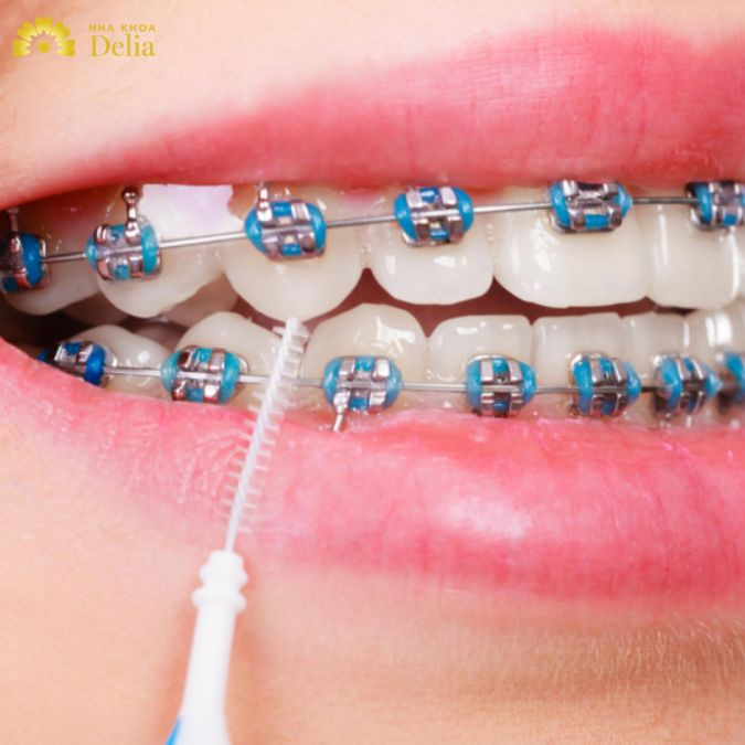 Niềng răng mắc cài kim loại trả góp nên hay không? Lưu ý những gì?