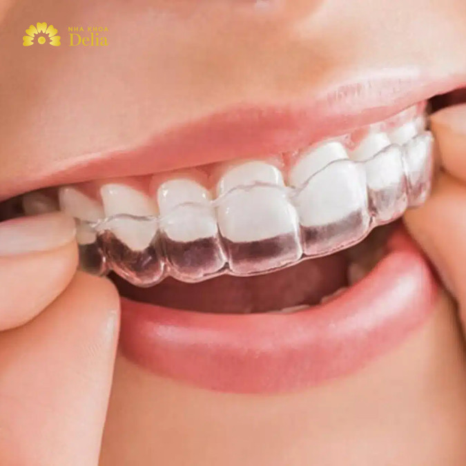 Giải đáp: Niềng răng trong suốt 1 hàm có được không?