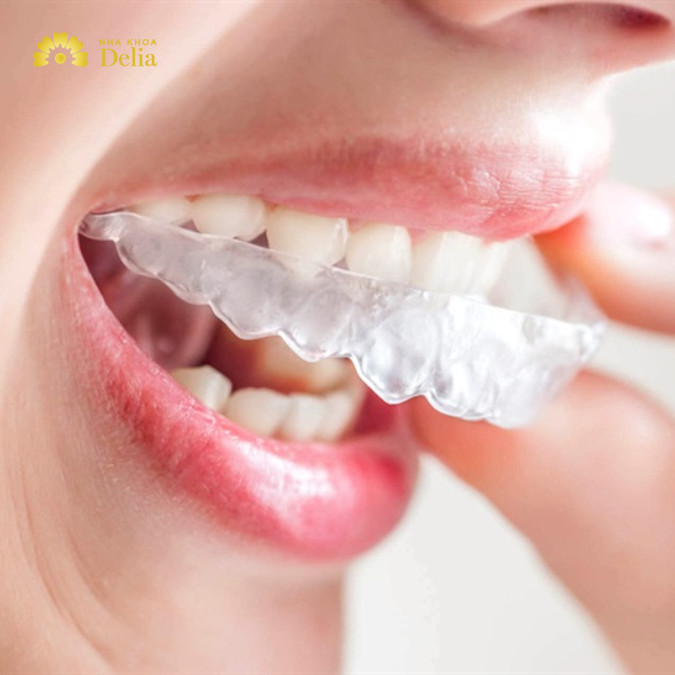 5 địa chỉ niềng răng trong suốt Hải Phòng uy tín, giá tốt nhất