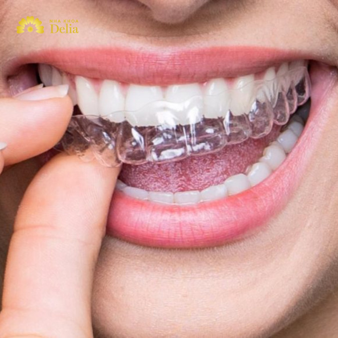 Niềng răng trong suốt mất bao lâu thì xong?