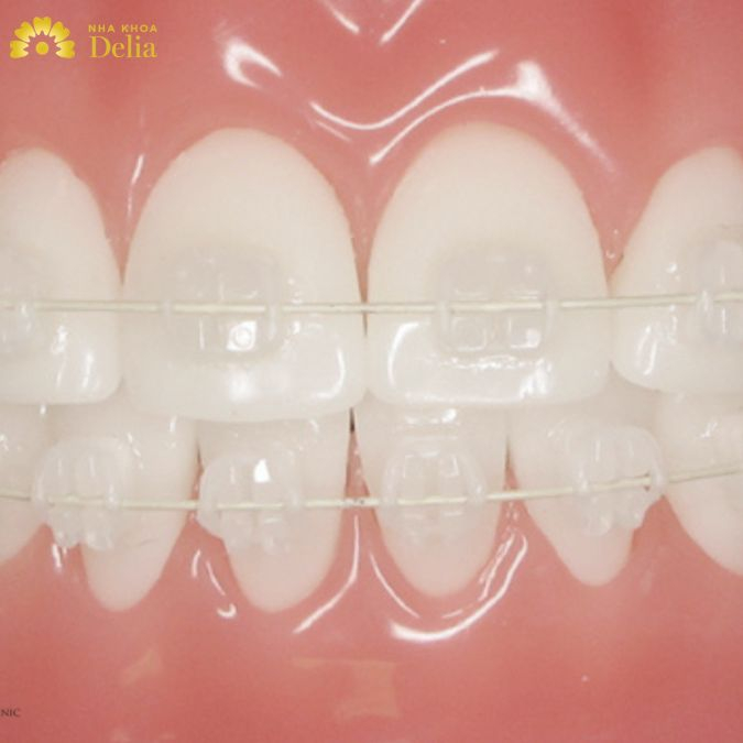 Quy trình niềng răng mắc cài sứ tại nha khoa Delia như thế nào?