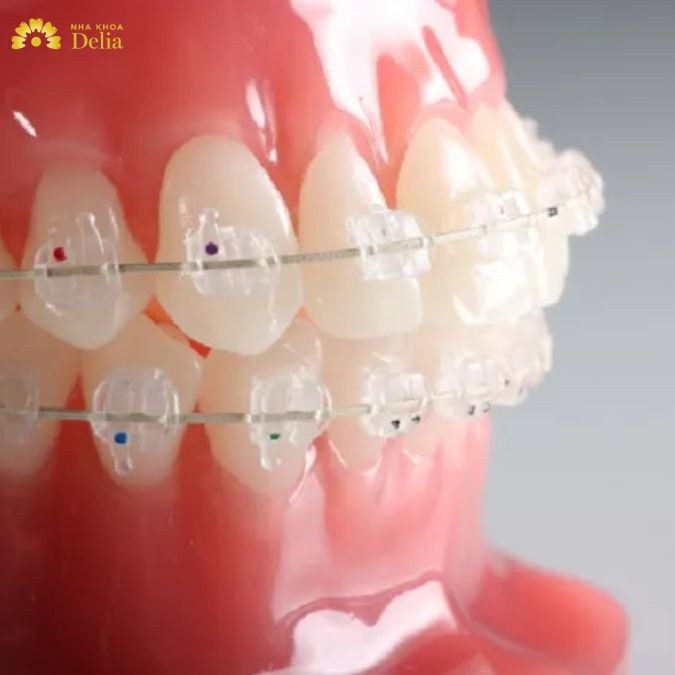 Niềng răng mắc cài Sapphire và những điều bạn cần biết