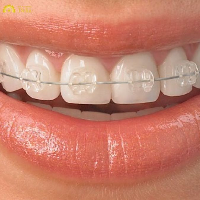 Niềng răng mắc cài Sapphire và những điều bạn cần biết